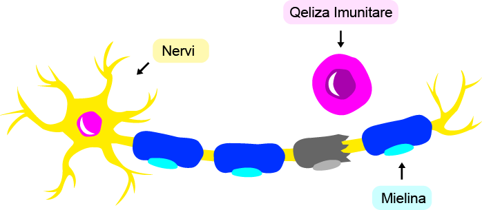 An immune cell damaging myelin on a nerve cell.