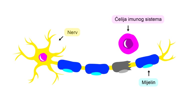 Kod multipla skleroze imuni sistem napada zaštitni omotač nerva, poznat kao mijelin, u mozgu.