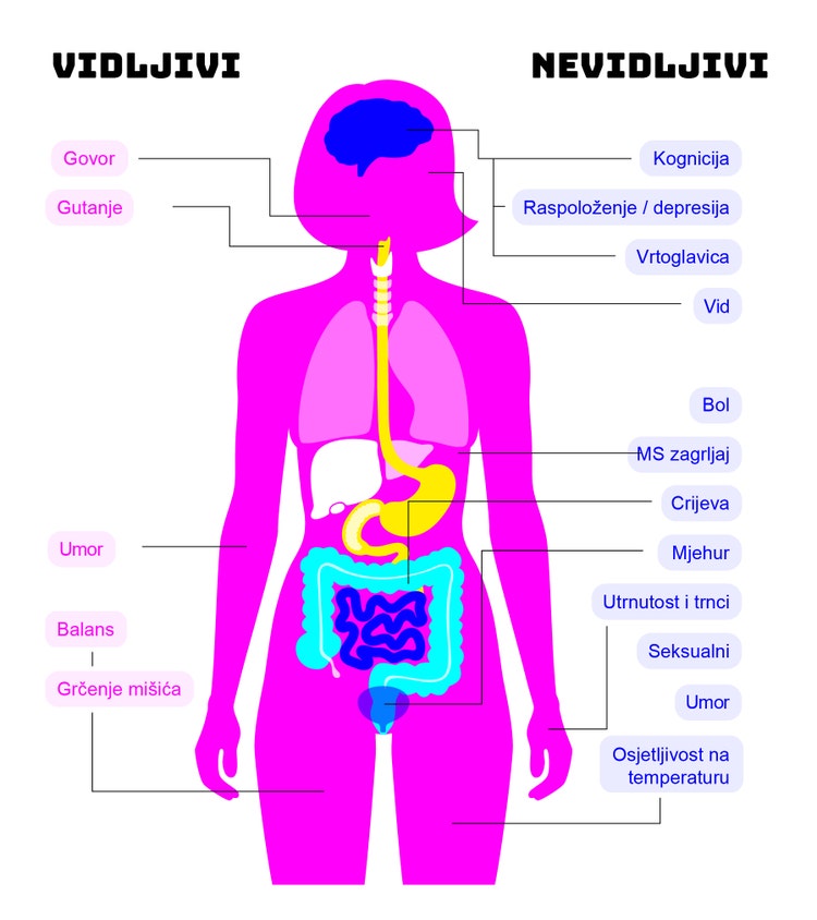 Anatomski dijagram žene s naljepnicama za vidljive i nevidljive simptome, koji označavaju relevantne dijelove tijela