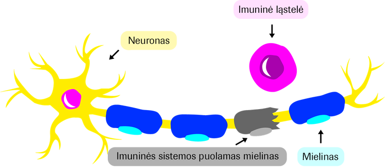 An immune cell damaging myelin on a nerve cell.