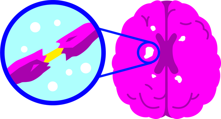 Diagram of brain with close-up of nerve showing damaged myelin sheath